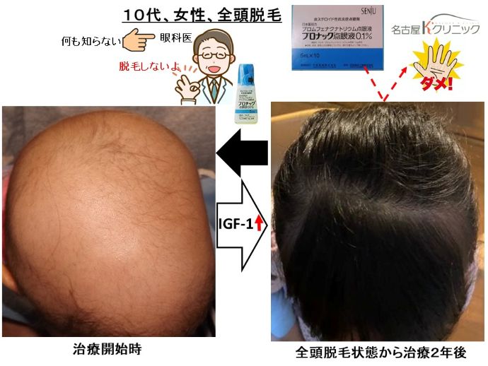 円形脱毛症　病院